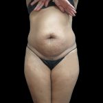 Liposuction Before & After Patient #2131