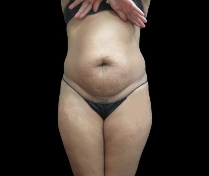 Liposuction Before & After Patient #2131