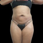 Liposuction Before & After Patient #2131