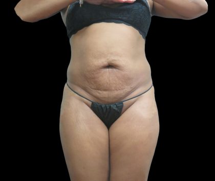 Liposuction Before & After Patient #2131