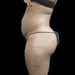Liposuction Before & After Patient #2131