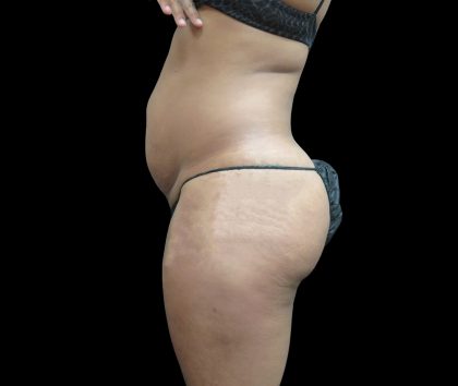 Liposuction Before & After Patient #2131