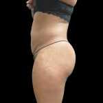Liposuction Before & After Patient #2131