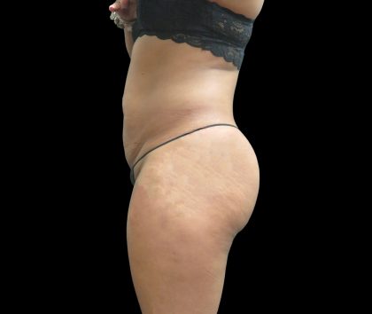 Liposuction Before & After Patient #2131
