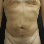 Liposuction Before & After Patient #2138