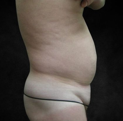 Liposuction Before & After Patient #2138