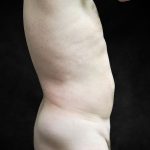 Liposuction Before & After Patient #2138