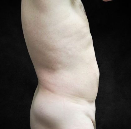 Liposuction Before & After Patient #2138