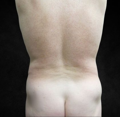 Liposuction Before & After Patient #2138