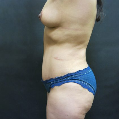 Liposuction Before & After Patient #2145