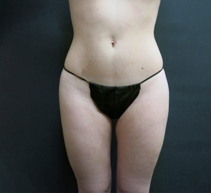 Liposuction Before & After Patient #2154