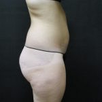 Liposuction Before & After Patient #2154