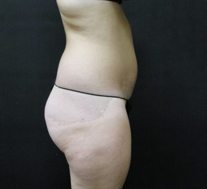 Liposuction Before & After Patient #2154