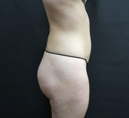 Liposuction Before & After Patient #2154