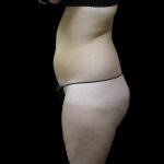 Liposuction Before & After Patient #2154