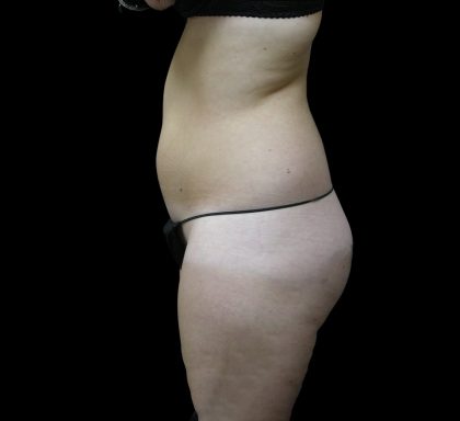 Liposuction Before & After Patient #2154