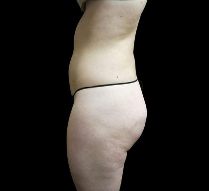 Liposuction Before & After Patient #2154