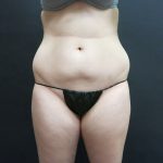 Liposuction Before & After Patient #2163