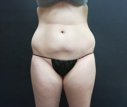 Liposuction Before & After Patient #2163
