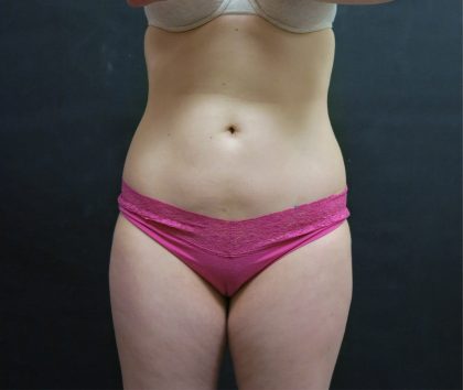 Liposuction Before & After Patient #2163
