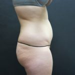 Liposuction Before & After Patient #2163