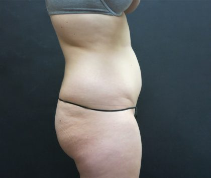 Liposuction Before & After Patient #2163