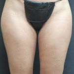 Liposuction Before & After Patient #2168