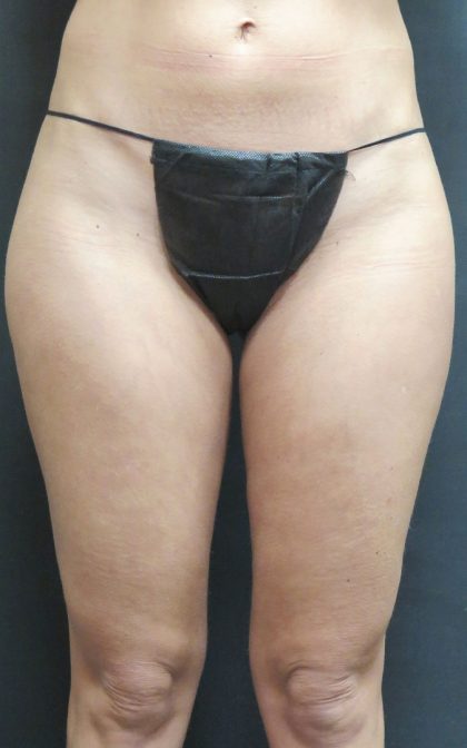 Liposuction Before & After Patient #2168