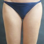 Liposuction Before & After Patient #2168