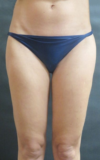 Liposuction Before & After Patient #2168