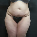 Liposuction Before & After Patient #2182