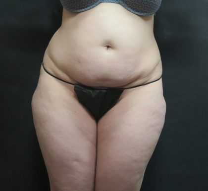 Liposuction Before & After Patient #2182