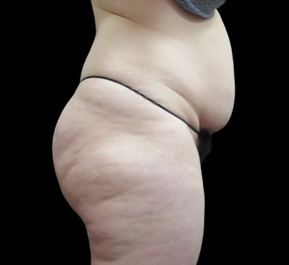 Liposuction Before & After Patient #2182