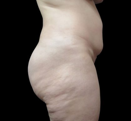 Liposuction Before & After Patient #2182
