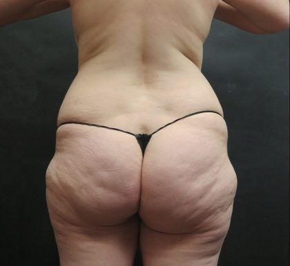 Liposuction Before & After Patient #2182