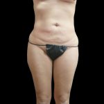 Liposuction Before & After Patient #2187