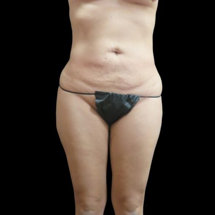 Liposuction Before & After Patient #2187