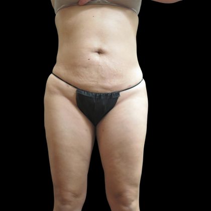 Liposuction Before & After Patient #2187