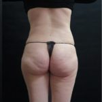 Liposuction Before & After Patient #2193