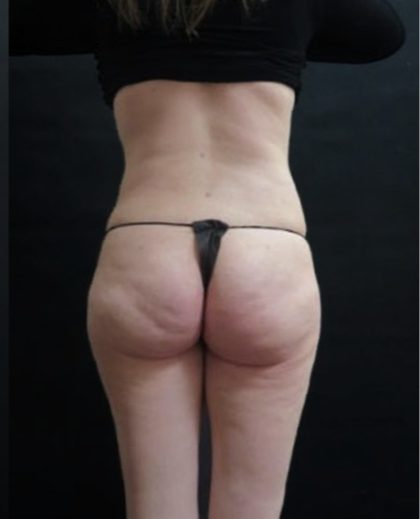 Liposuction Before & After Patient #2193