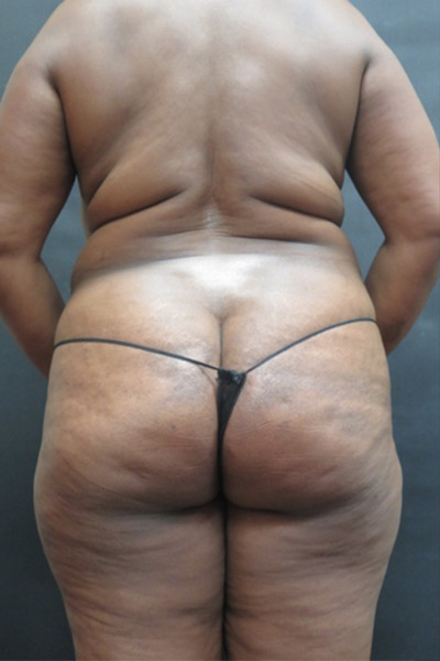 Liposuction Before & After Patient #2196