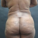 Liposuction Before & After Patient #2196