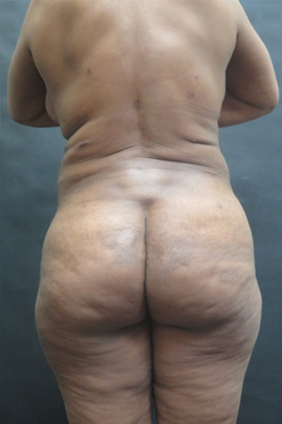 Liposuction Before & After Patient #2196