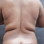 Liposuction Before & After Patient #2201