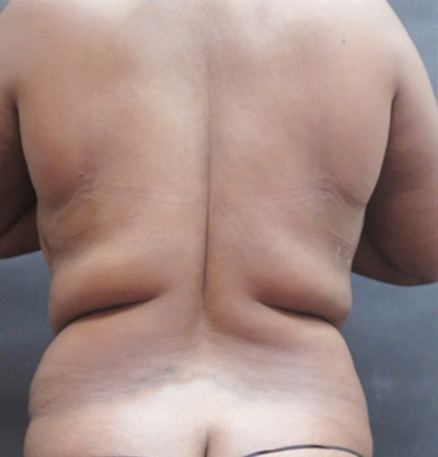 Liposuction Before & After Patient #2201