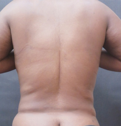 Liposuction Before & After Patient #2201