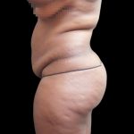 Liposuction Before & After Patient #2201