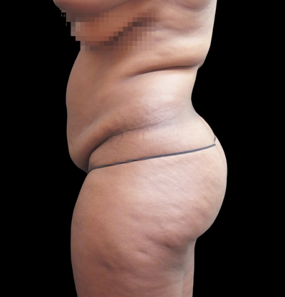 Liposuction Before & After Patient #2201