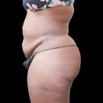 Liposuction Before & After Patient #2201