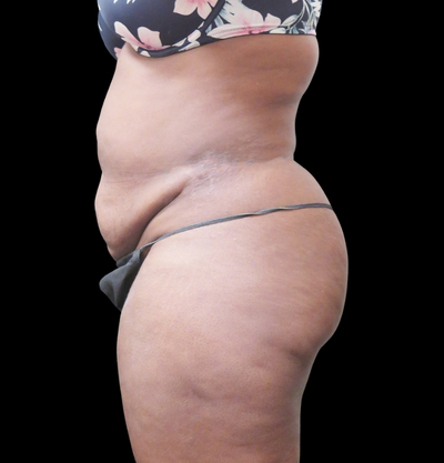 Liposuction Before & After Patient #2201